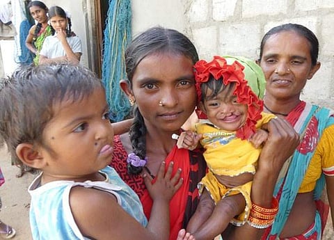 A few children with cleft lips before the operation