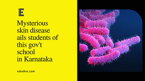 This infection is being attributed to a myriad of things, ranging from unclean water to insect bites. | Pic: Edex Livec
