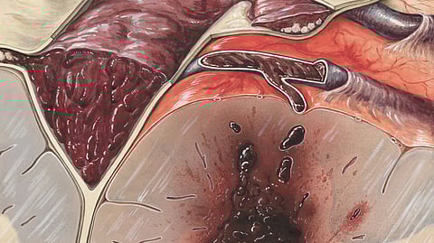 World Thrombosis Day 2025 sheds light on prevention and awareness 