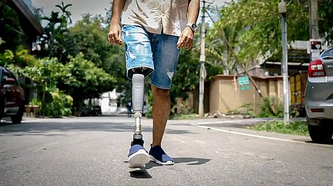 Around 300 beneficiaries to receive prosthetic limbs in Thane camp