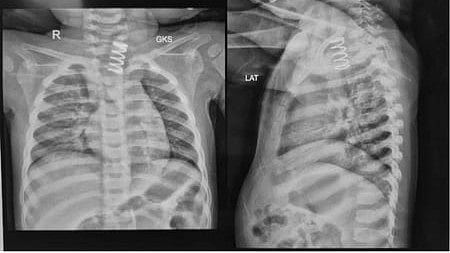 AIIMS doctors remove 2-inch-long metal spring from 14-month-old