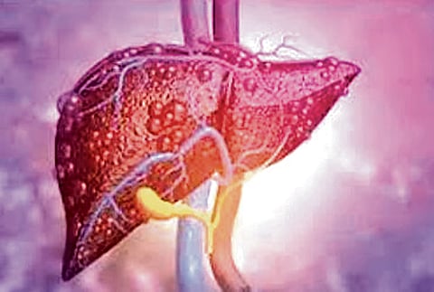 Sleep crisis that fattens the liver