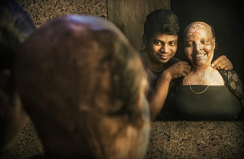 From a 17-year-old acid attack victim to a 25-year-old survivor: Here's Rani's journey  
