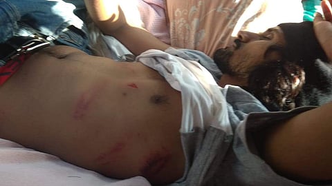 Kumar was targetted by the police and lathi-charged, leaving him with a broken wrist and injuries all over his body