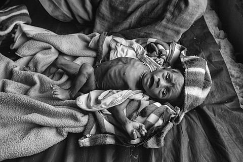 A malnourished child | (Pic: Sudharak Olwe)