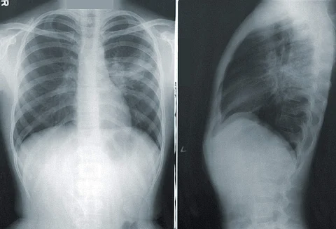 Detecting COVID through chest X-rays
