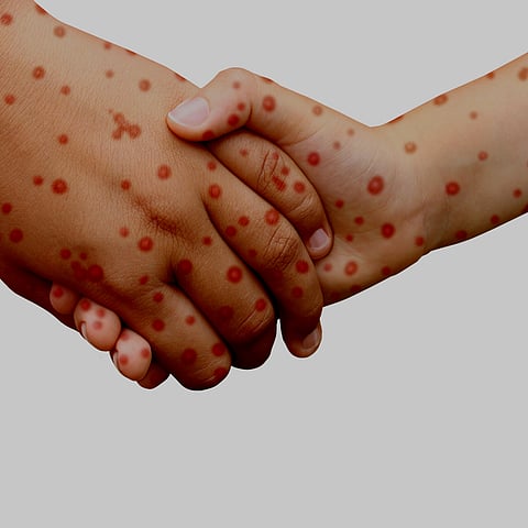 #WhatTheFAQ: Are Measles making a comeback in Mumbai? Here's what you need to know